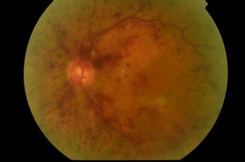 Central Serous Retinopathy | NeoRetina Clinic