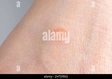 Streptoderma Dermatitis En La Piel Humana Punto Redondo Rojo