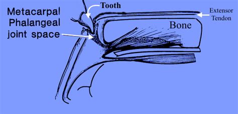 Human Bite Hand Surgery Source