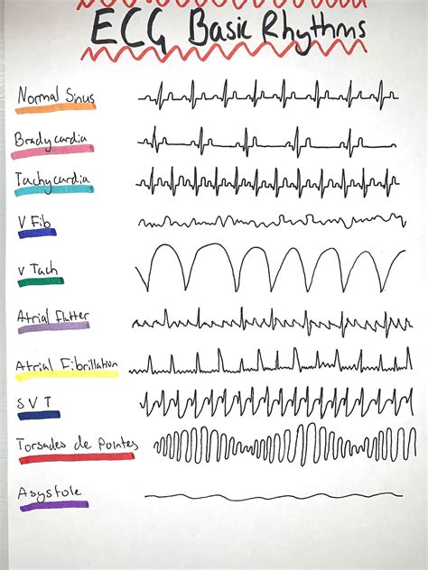 ECG Basic Rhythms - Etsy