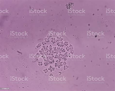 Microscopic Fungi Malassezia Furfur Showing Yeast Cells And Hyphae Dermatophytes Nail Scraping