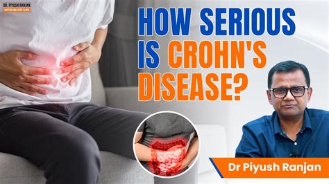 How Serious Is Crohn S Disease Crohn S Disease Causes Symptoms