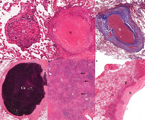 A Early Non Necrotizing Granuloma The Lymphocyte Rim L Appears