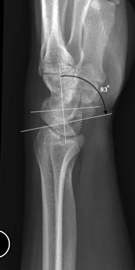 Scapholunate Ligament Injury And Disi Hand Medbullets Step 1