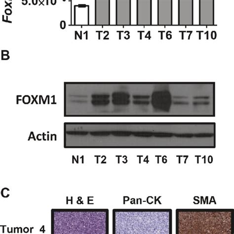 Foxm1 Expression In Rb1trp53 Knockout Driven Murine Ovarian Cancer