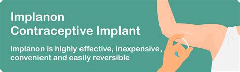 Implanon contraceptive implant - General Practitioners Ringwood ...