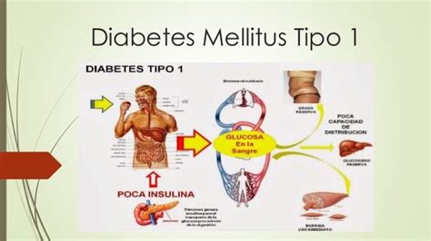 Diabetes Mellitus Tipo 1