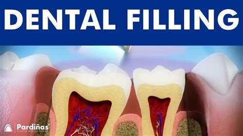 Dental filling or composite restoration - Tooth decay treament ...