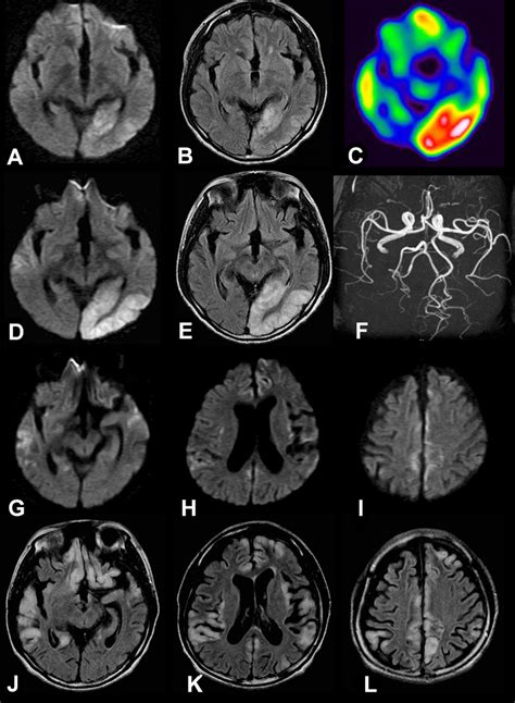 Neuroimaging Of Patient 2 Adult Onset Melas Brain Mris A B And