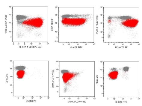 Acute Undifferentiated Leukemia Flow Cytometry