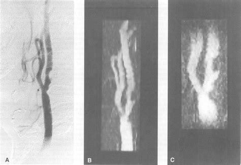 A Intra Arterial Digital Subtraction Angiogram Showing Ulcerated