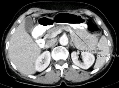 Ct Scan Image Of The Abdomen Highlighting At Pancreas Tail The Download Scientific Diagram