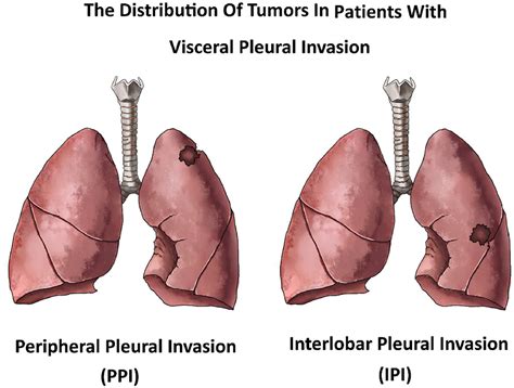 The Location Of Visceral Pleural Invasion In Stage Ib Patients With Non