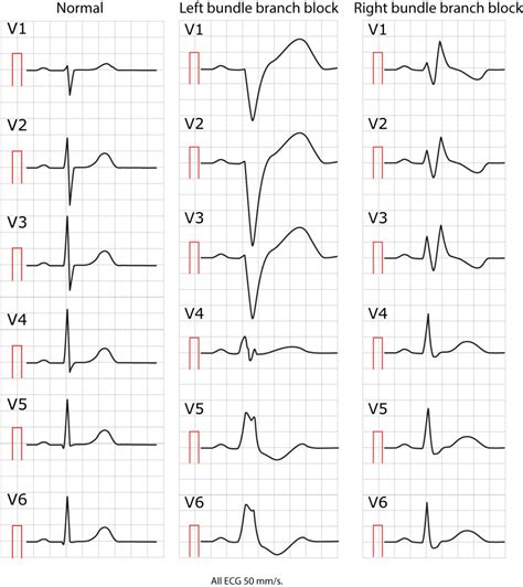 Figure 1. Normal ECG, left bundle branch block and right bundle branch ...