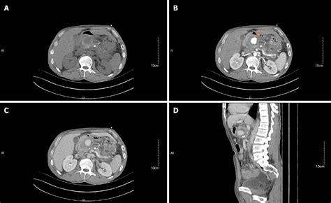 Pdf Hemosuccus Pancreaticus Caused By Gastroduodenal Artery