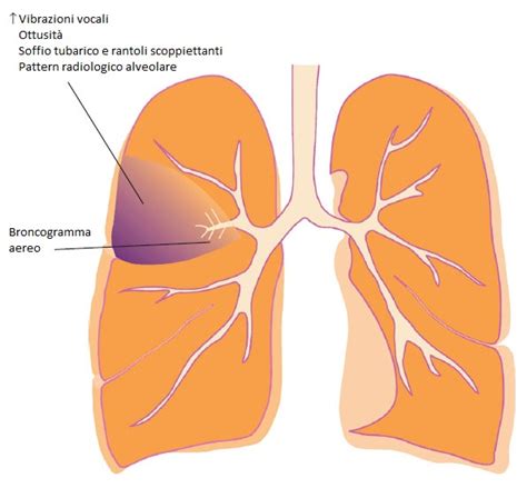 Il Consolidamento Parenchimale Polmonare Addensamento Polmonare