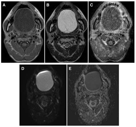 Epidermoid Cyst Floor Of Mouth Mri Viewfloor Co