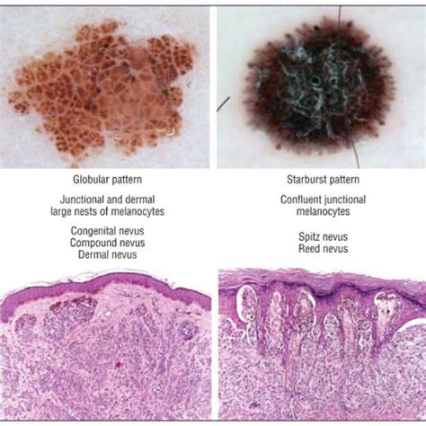 The 4 Main Dermoscopic Morphologic Structures Of Nevi Correspond To