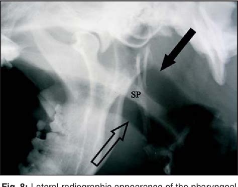 Figure 5 From Folded Fl Ap Palatoplasty For Treatment Of Elongated Soft