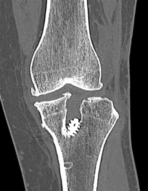 Revision ACL Reconstruction Adam B Cohen MD