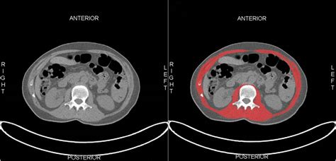 The Association Between Skeletal Muscle Measures And Chemotherapy