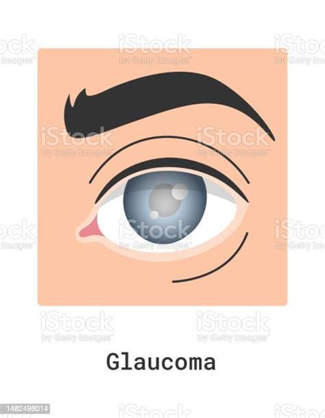 Ilustración De Glaucoma Enfermedad Del Ojo Humano Y Más Vectores Libres