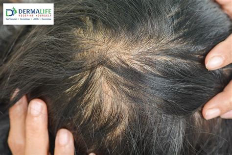 Causes and Treatments of Hair Thinning