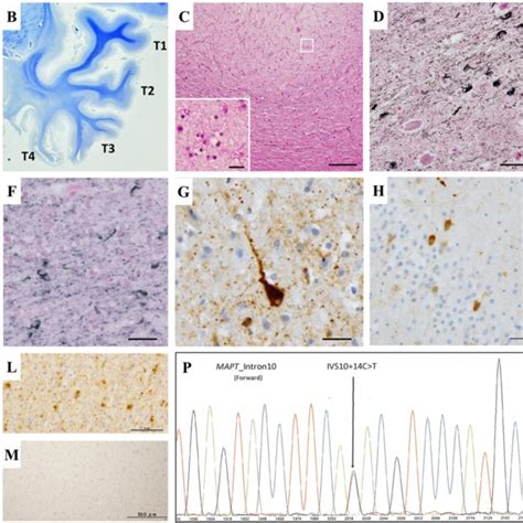 Neuropathological Biochemical And Genetic Findings A Severe