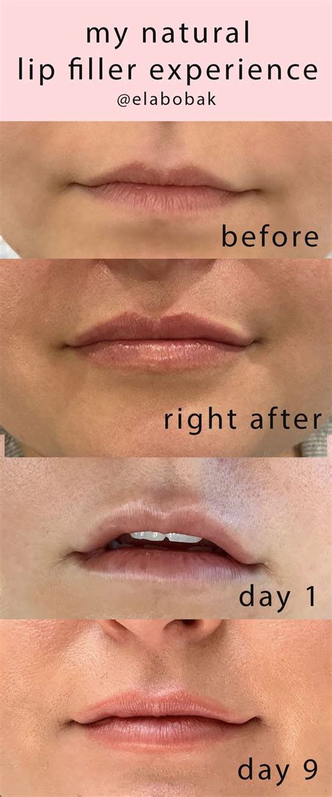 I Wanted Natural Looking Plumped Lips My Lip Filler Experience Lip