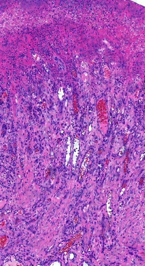 Pathology of Pyogenic Granuloma | Pathology, Blog