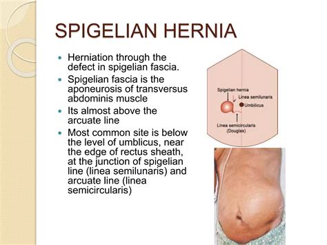 VENTRAL HERNIA.pptx