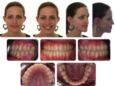 10 Orthognathic Surgery Pocket Dentistry