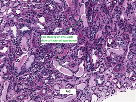 Kidney Biopsy Of The Month Light Chain Cast Nephropathy Renal Fellow