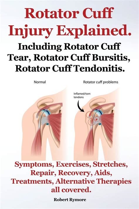 Rotator Cuff Repair Rehab Protocol Ubicaciondepersonascdmxgobmx