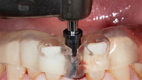 Getting Dental Implants Right With Guided Surgery Enamel Clinics