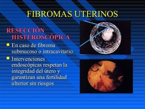 Fibromas Uterinos 95 Y 97