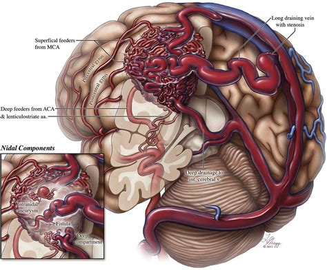 Figure 1 from Endovascular treatment of cranial arteriovenous malformations and dural ...