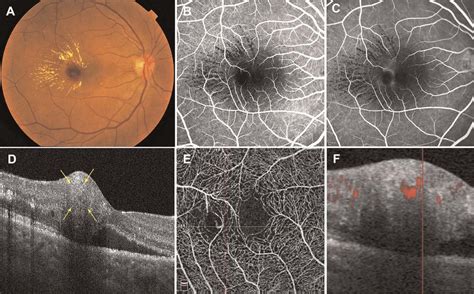 Multimodal Imaging At The Latest Visit Days After The Second