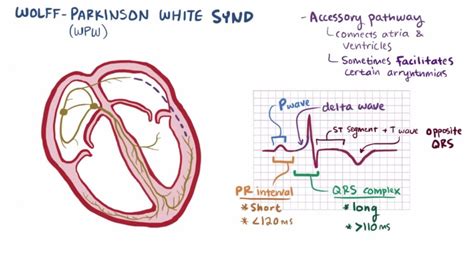 Wolff Parkinson White Syndrome Causes And Complications