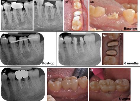 Present Status And Future Directions Surgical Extrusion Intentional