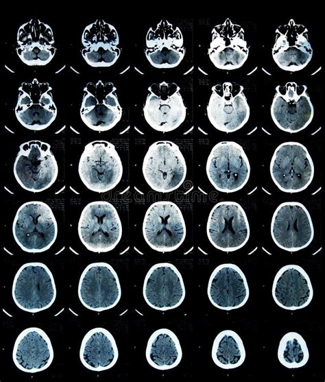 Brain CT Scan Stock Image Image Of Injury Brain Magnetic 15340269