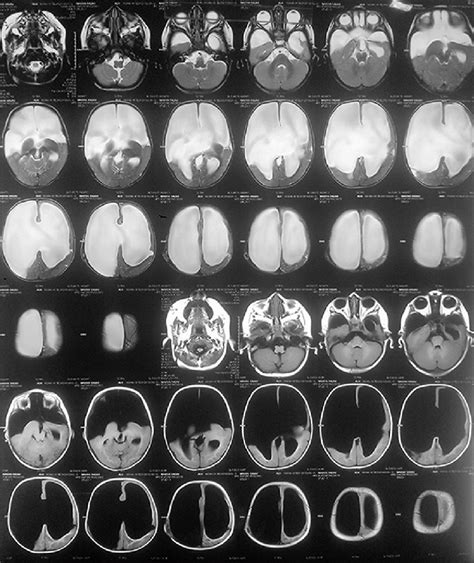 Magnetic Resonance Imaging Brain Axial Section Showing Large Download Scientific Diagram