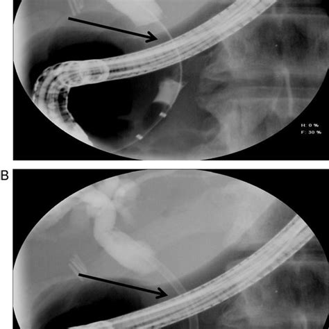 Cholangiogram From The Ercp Depicting A The Area Of Obstruction Download Scientific Diagram