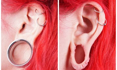 Earlobe Repair, Surgery for Stretched or Split Ear Lobes | Earlobes ...