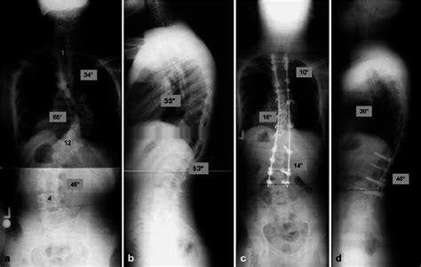 A 20 Year Old Male Manifesting Adolescent Idiopathic Scoliosis With A