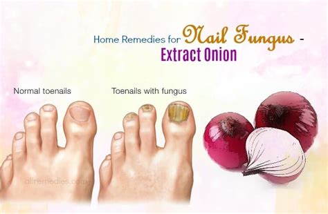 6 Natural Home Remedies For Nail Fungus Infections