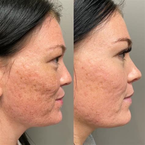 Pixel 8 RF Microneedling Bee Queen MedInk Aesthetics