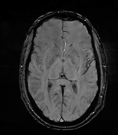 Meningioma Image Radiopaedia Org