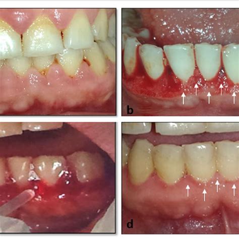 Clinical View Of Gingival Enlargement In Mandibular Incisors Area