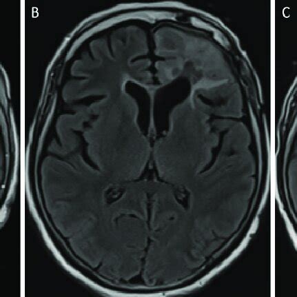 A: Axial T1-weighted MRI with contrast showing cystic encephalomalacia ...